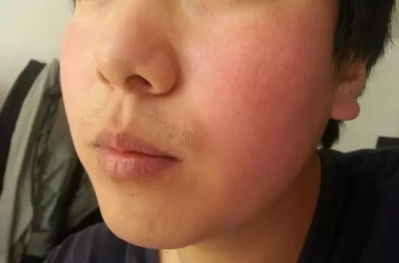 紅血絲的種類有哪些？