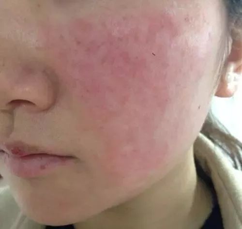 紅血絲的種類有哪些？