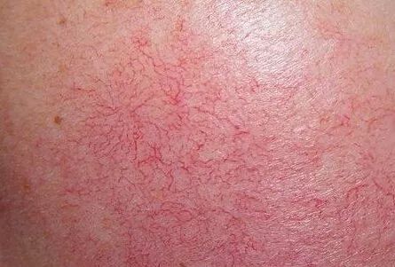 紅血絲的種類有哪些？