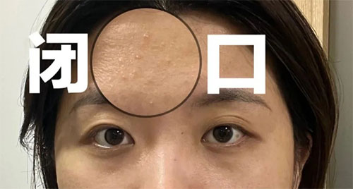 閉口粉刺形成的原因有哪些？