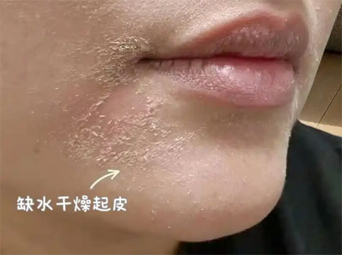 臉部脫皮干燥脫屑是怎么回事？